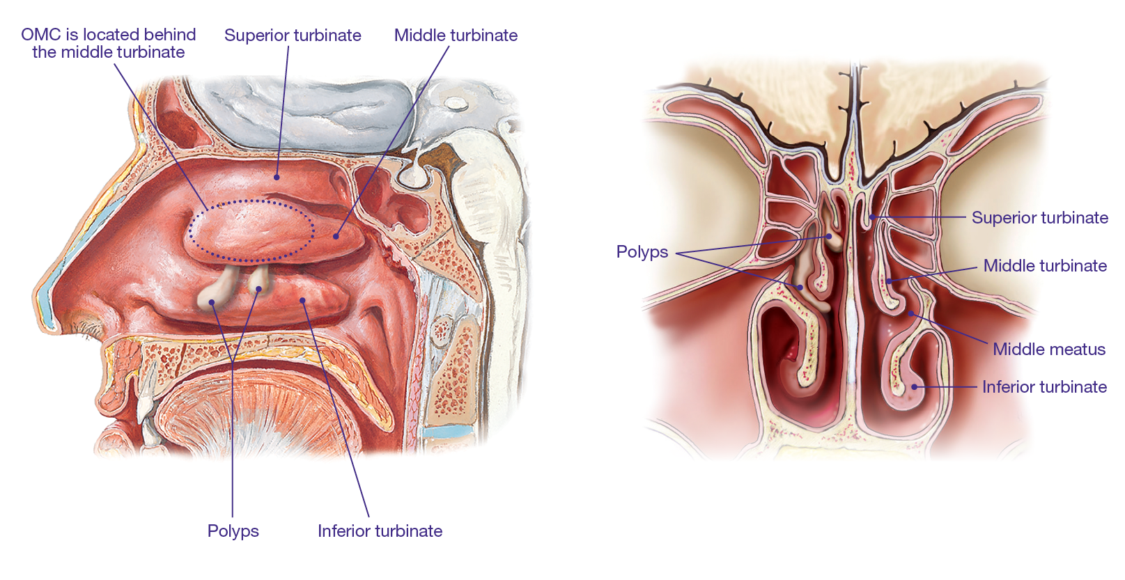 nasal-polyps-symptoms-causes-and-treatments-sinus-infection