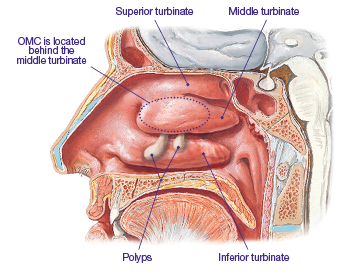 Graphic of nasal passages showing polyps, that OMC is located behind the middle turbinate, and where the superior, middle, and inferior turbinates are located