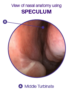 Graphic of view of nasal anatomy using a speculum in the middle turbinate