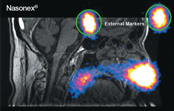 Graphic of example of single-photon emission computed tomography (SPECT)/MRI image for Nasonex® deposition in the nasal cavity