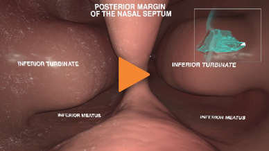 Video of the journey through the nasal anatomy using the Exhalation Delivery System