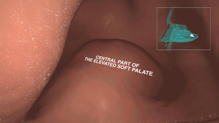 Image of the dynamics of the Exhalation Delivery System to elevate and seal the soft palate